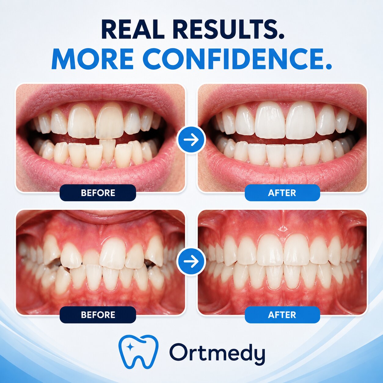 Ortmedy Align results